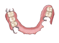 部分義歯