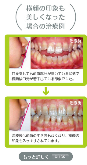 歯並びの悪さは、お口の健康に影響します